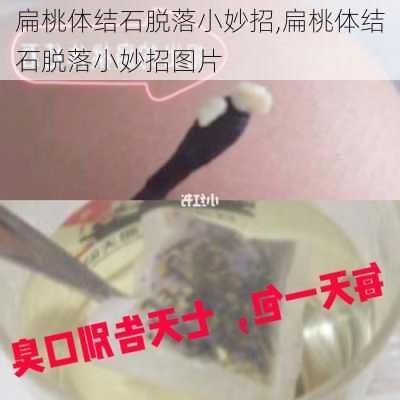 扁桃体结石脱落小妙招,扁桃体结石脱落小妙招图片-第2张图片-花卉百科